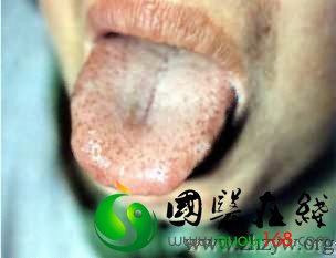 淡红红点舌白腻水滑苔